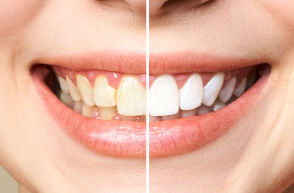 Non-white teeth: Reasons and ways to overcome